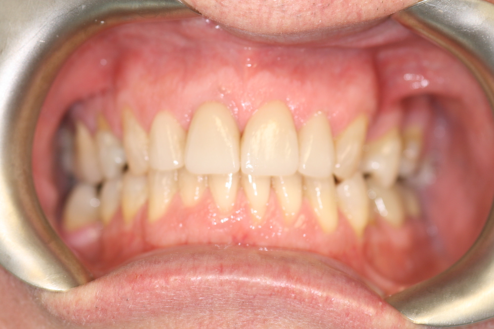 Dental Crowns Greensboro NC Bella Dental