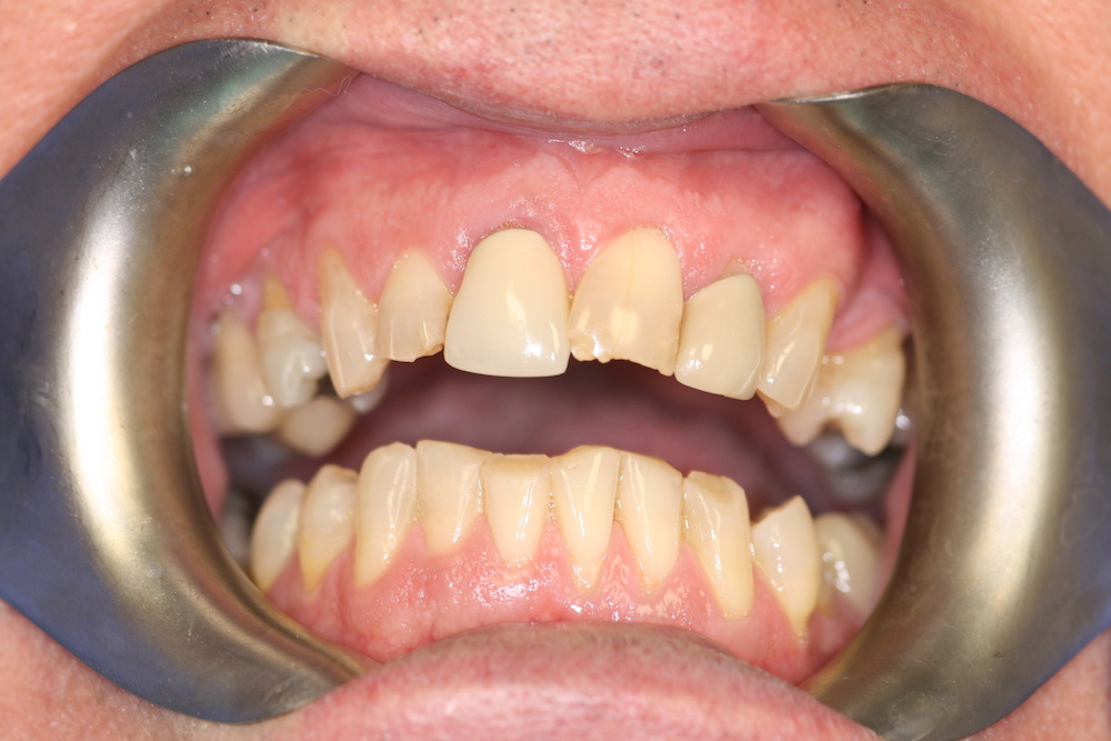 Dental Crowns Greensboro NC Bella Dental