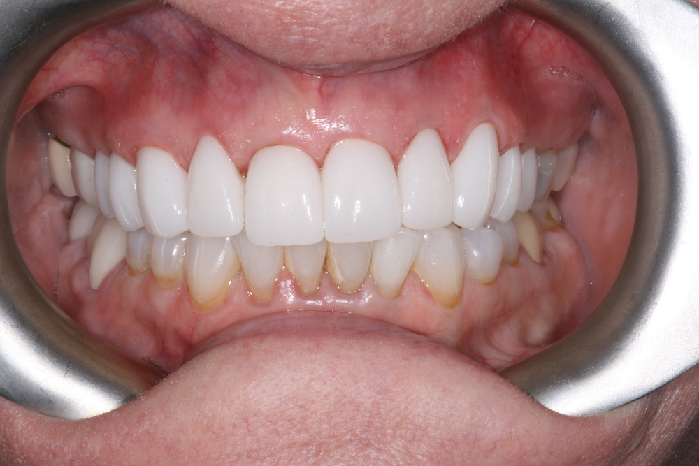 Dental Crowns | Dentist Greensboro NC | Bella Dental