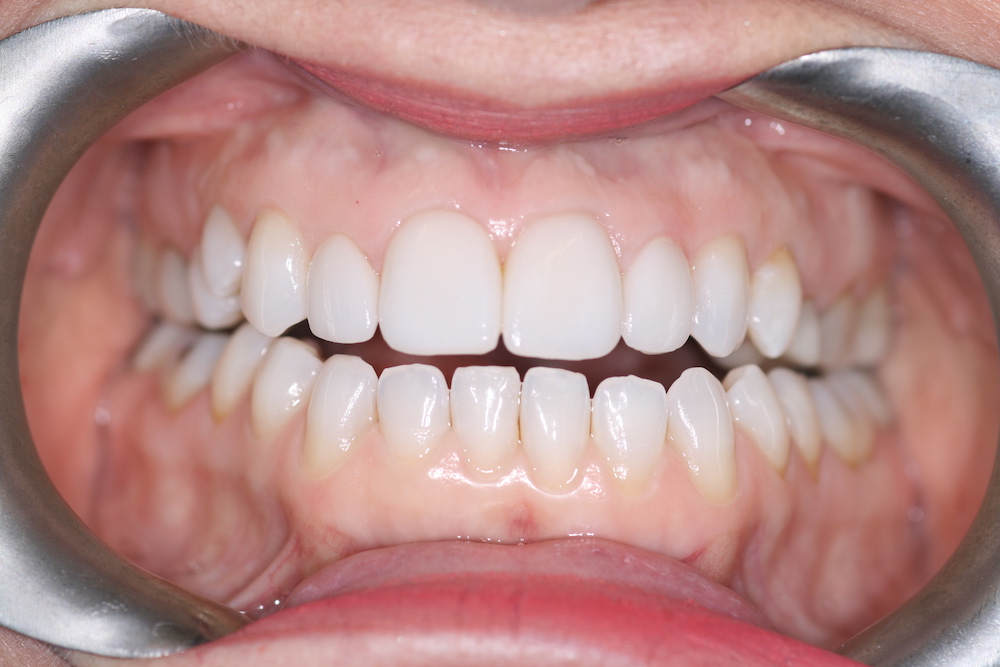 Porcelain Veneers Greensboro NC Bella Dental